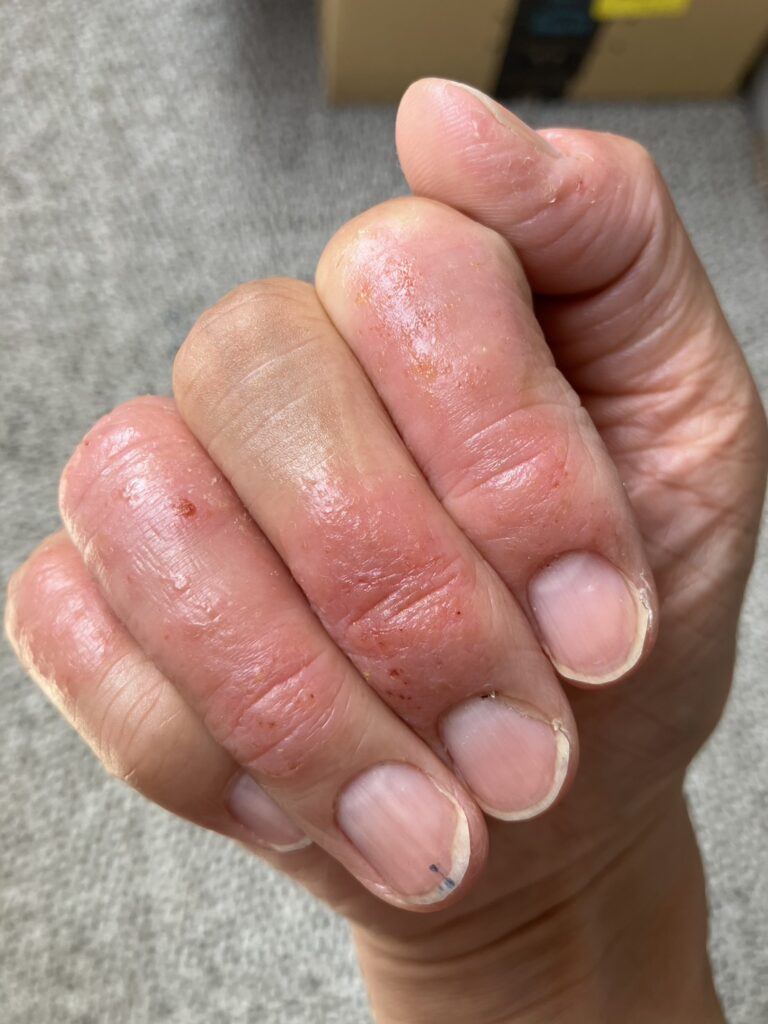 指 水ぶくれ