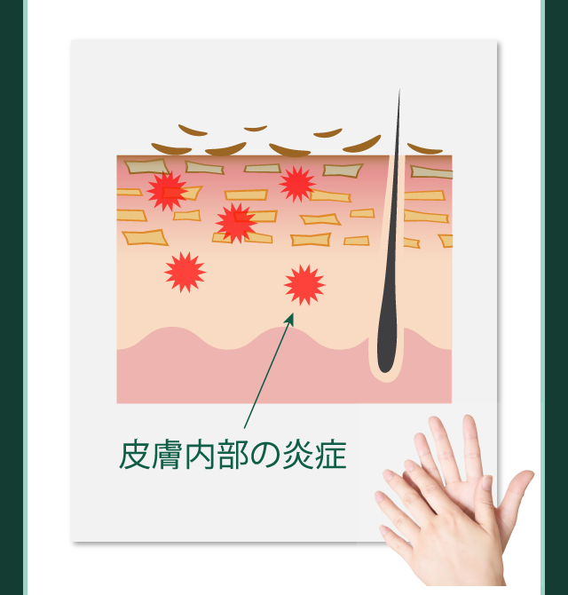 皮膚内部の炎症が、ガサガサの原因に