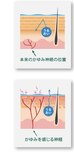 かゆみの原因/伸びたかゆみ神経