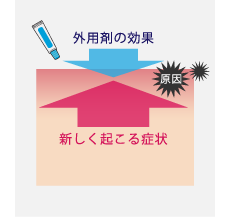 外用剤では抑えきれない新しく起こる炎症