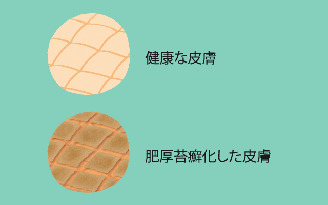 肥厚苔癬化した肌のイメージ