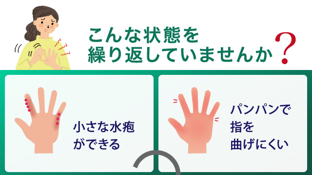 こんｎ状態を繰り返していませんか？小さな水疱ができる。パンパンで指を曲げづらい