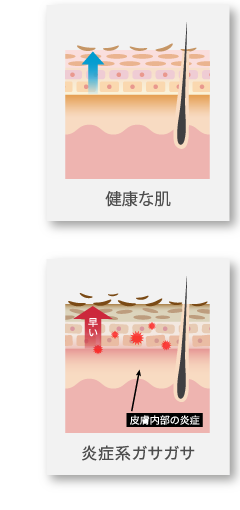 炎症系ガサガサの特徴｜未熟な角層のバリア機能